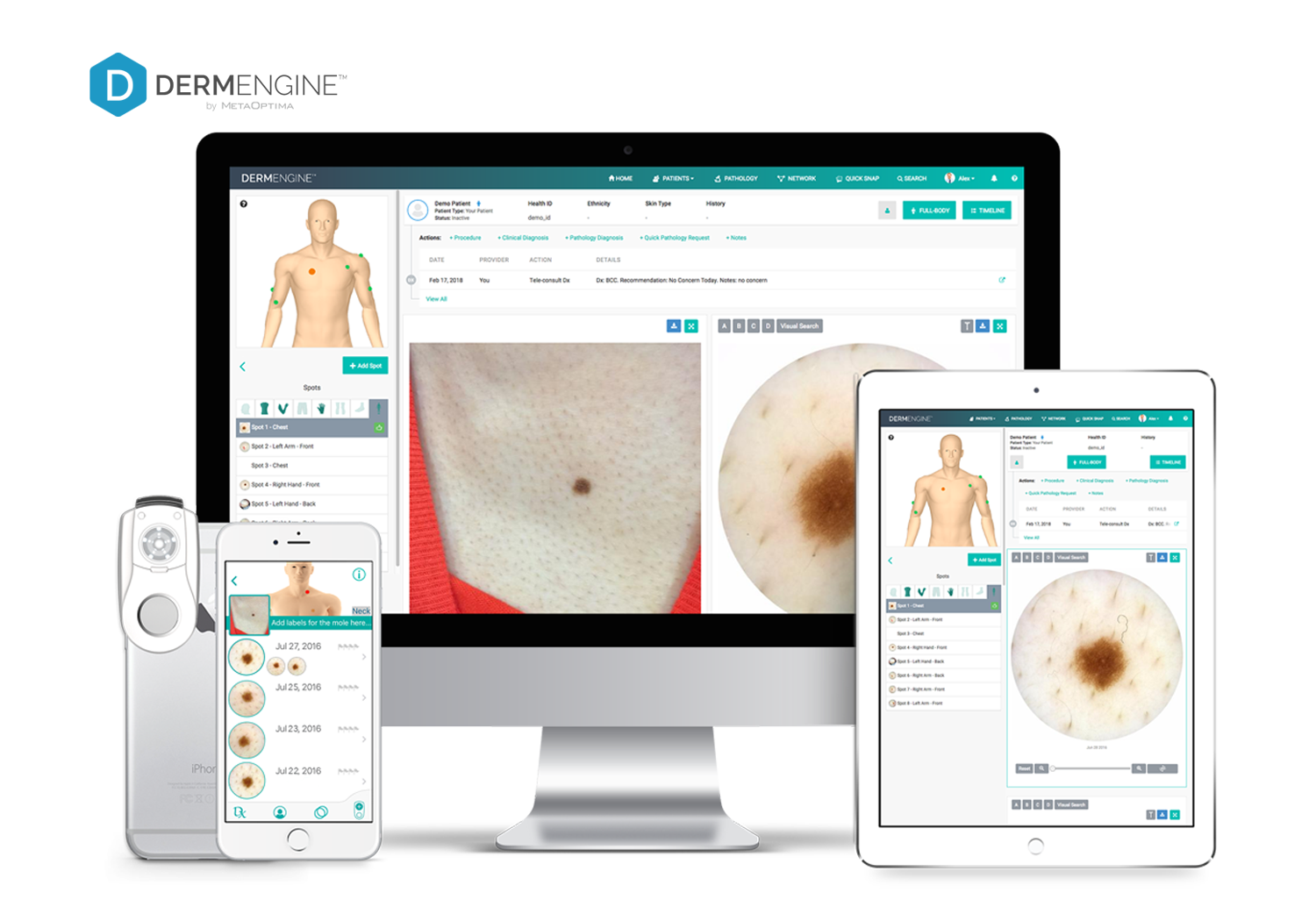 DermEngine devices MoleScope