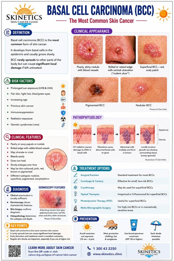 skinetics-basal-cell-carcinoma-poster-final8BC1230F-A7A1-6989-E56A-9AAADD31BABA.jpg